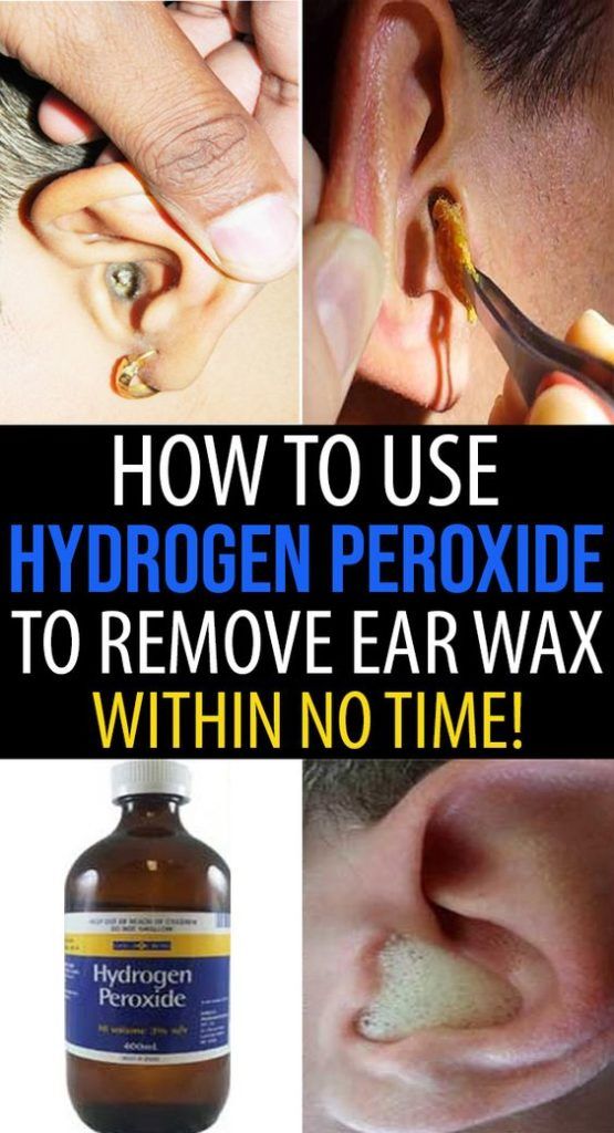 How To Use Hydrogen Peroxide To Remove Ear Wax?#exercise #benefits # ...