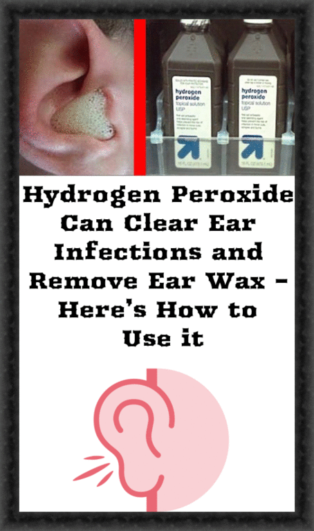 Hydrogen Peroxide Can Clear Ear Infections and Remove Ear Wax â Hereâs ...