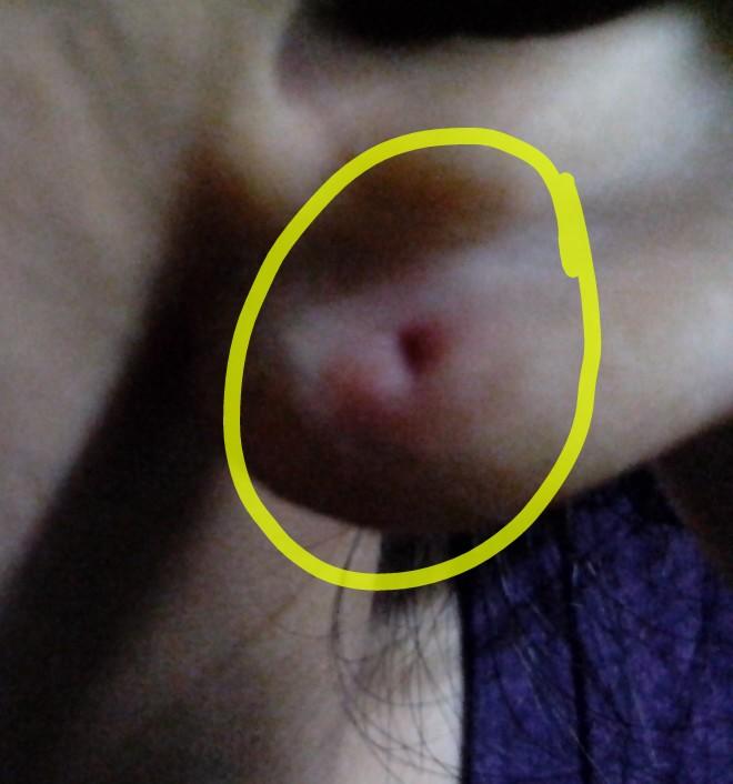 Is my old ear piercing infected?