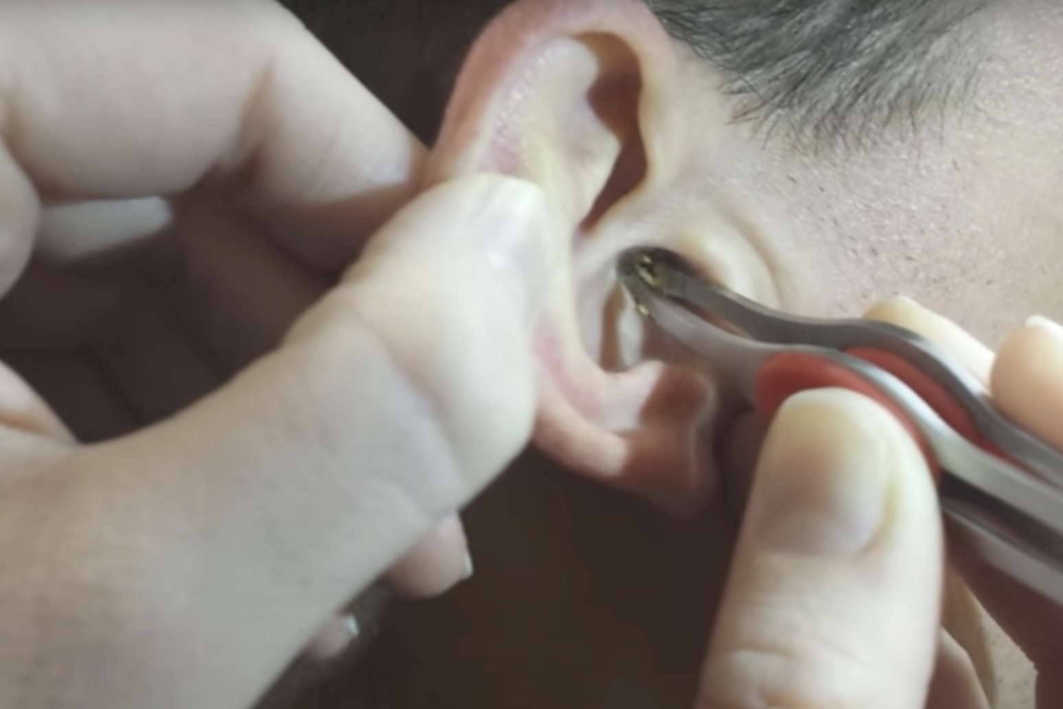 Man Has Gross Amount of Ear Wax Removed from Ear Canal