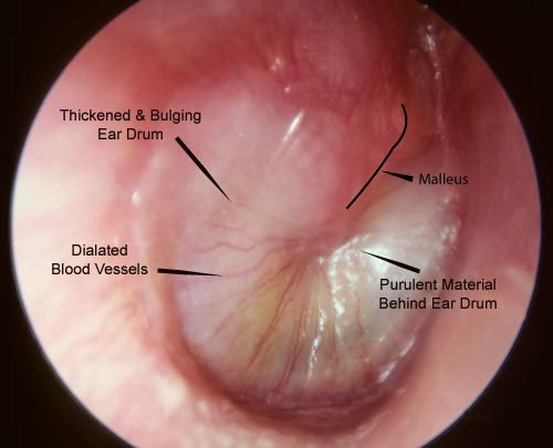 Middle Ear Infection Images