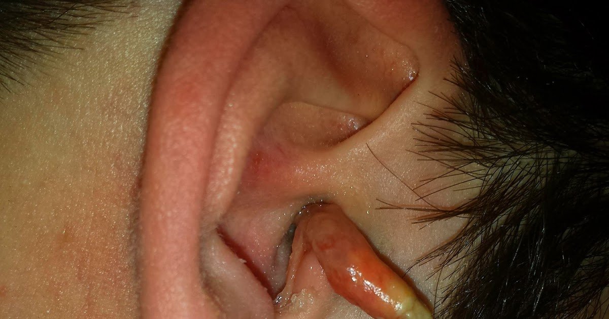 Mr. ZIT: CRAZY EAR INFECTION
