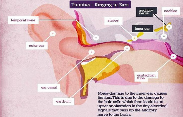 Natural Home Remedies for Tinnitus to Stop Ringing in ears ...