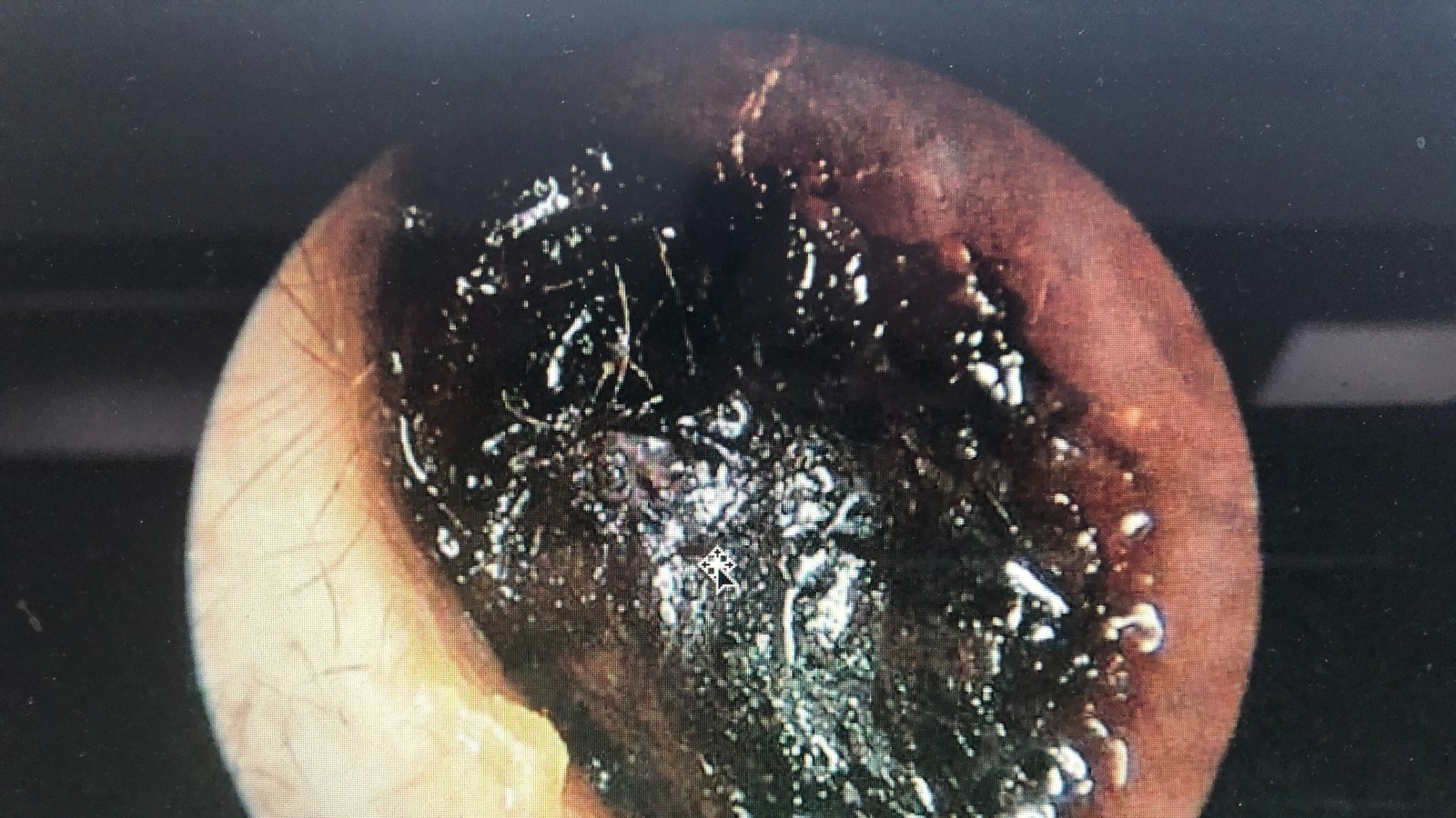 Petition · Ear wax removal should be available on the NHS ...