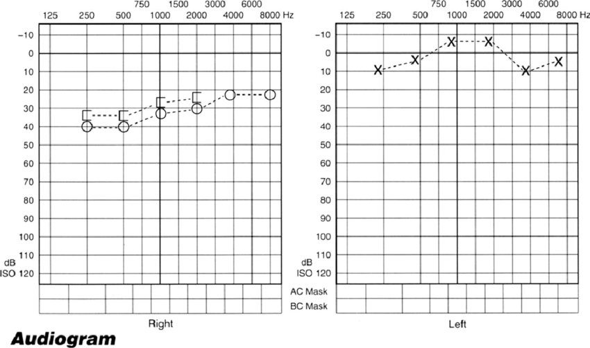 Pure tone audiogram showing 30