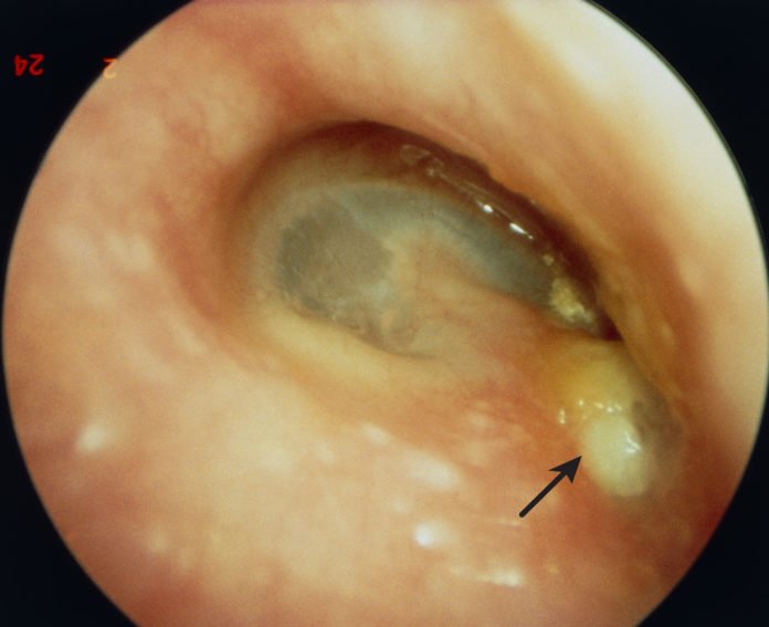 Pus in Ear: Condition, Signs, Treatment, and More ...