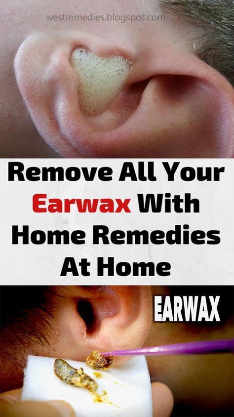 Remove All Your Earwax With Home Remedies At Home