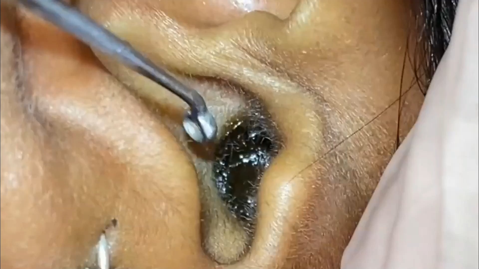 Removing ear wax from both ears : PoppingPimple