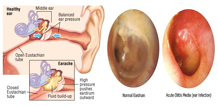 Signs of an Ear Infection