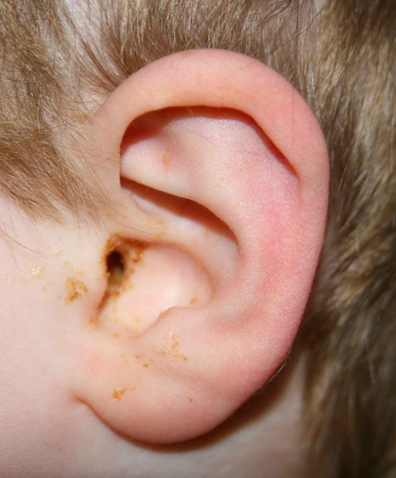Signs of Ear Infection in Toddler