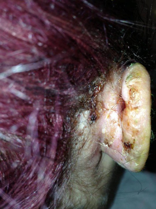 Student loses half her ear after piercing goes wrong