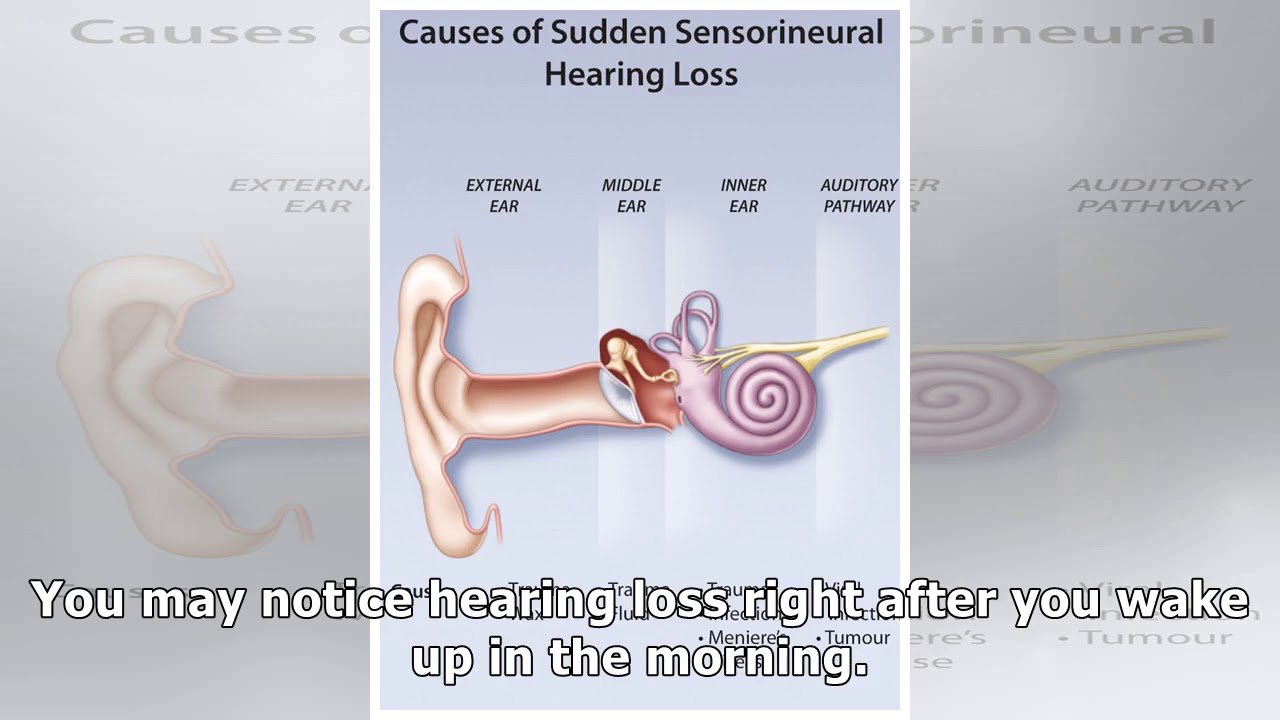 Sudden Sensorineural Hearing Loss: Causes, Symptoms, and ...