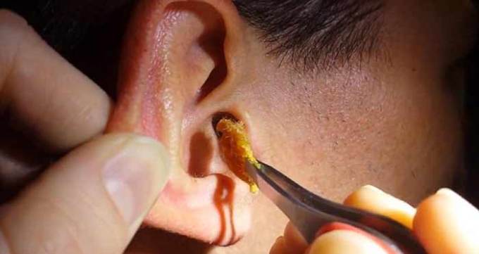 Swimmers Ear Drops Recipe Peroxide