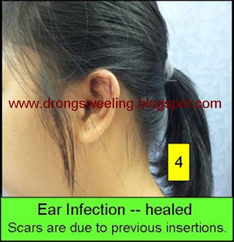 TCM News: How TCM Physicain Cures Ear Infactions