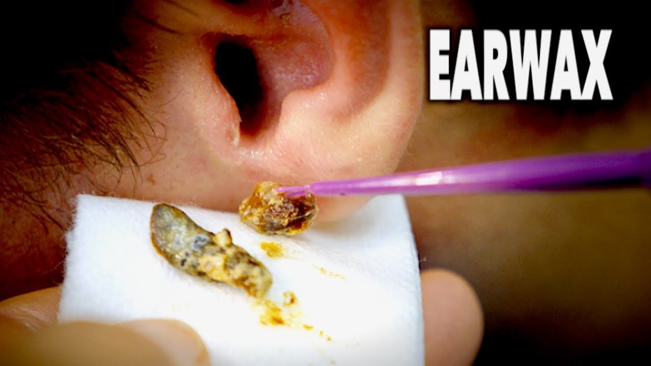 THE BEST EARWAX REMOVAL EVER! (and most gross)