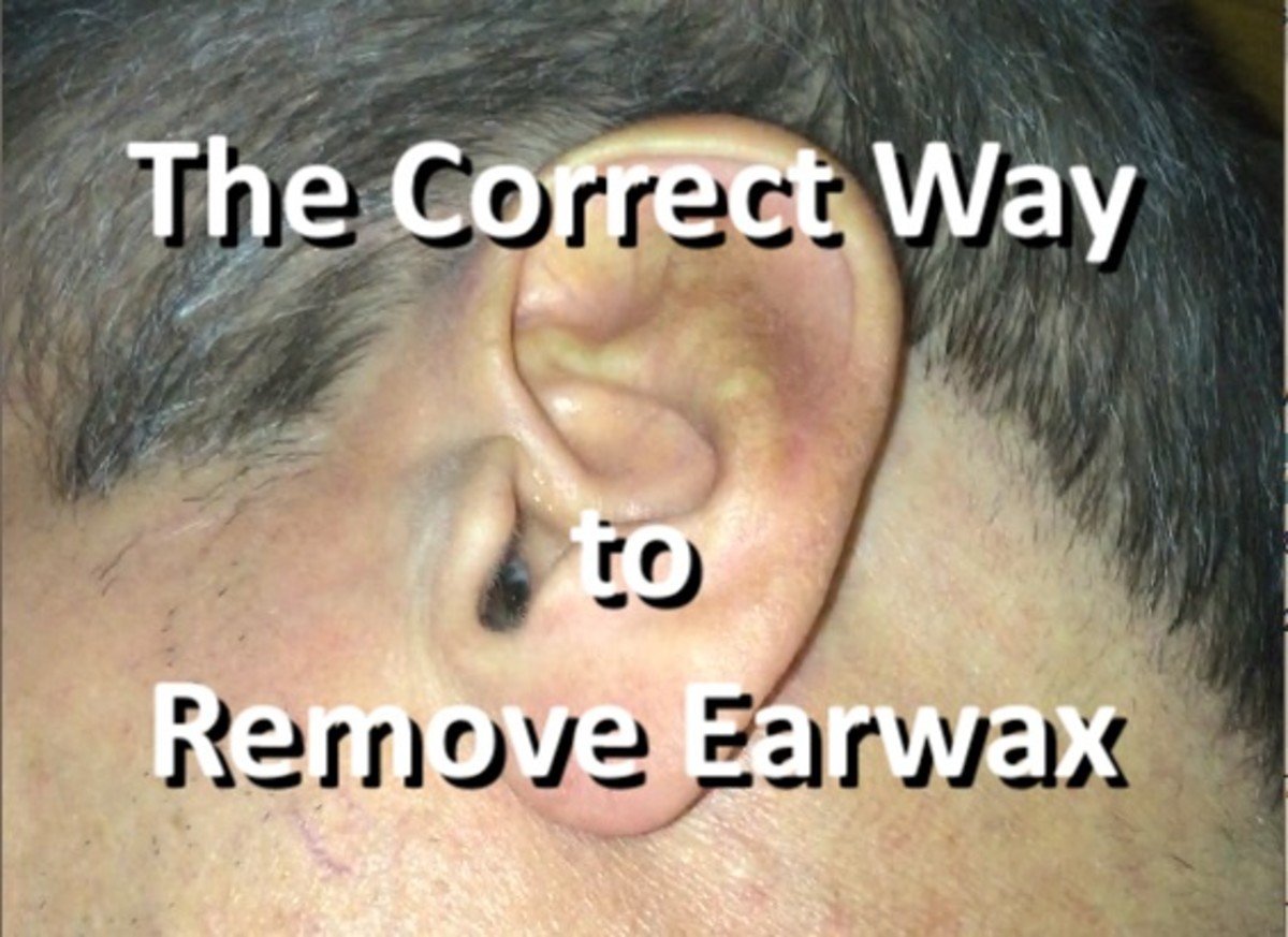 The Correct Way to Remove Impacted Earwax That Worked for Me