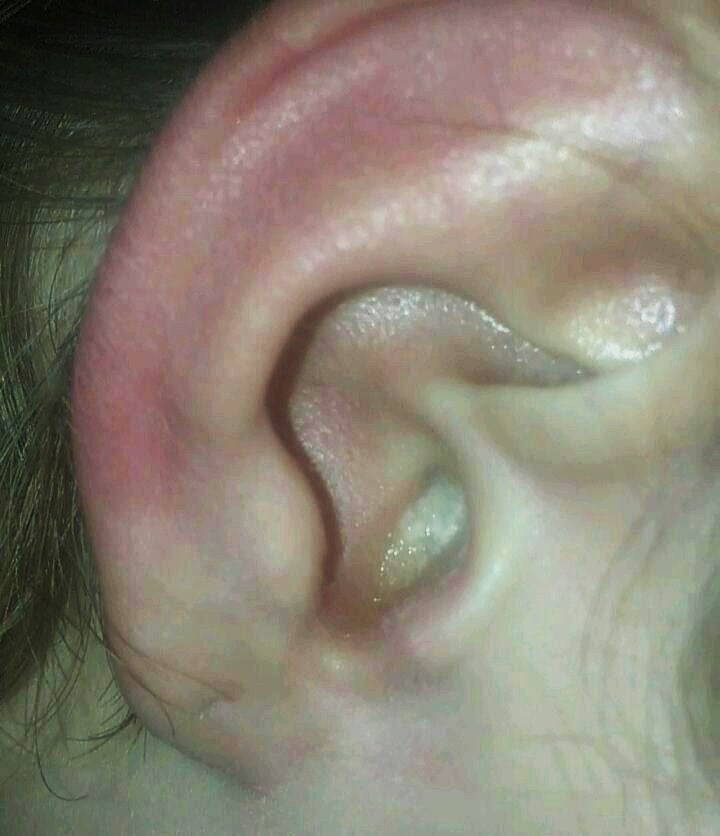 This is my ear infection (otitis media &  otitis externa) hurts like ...