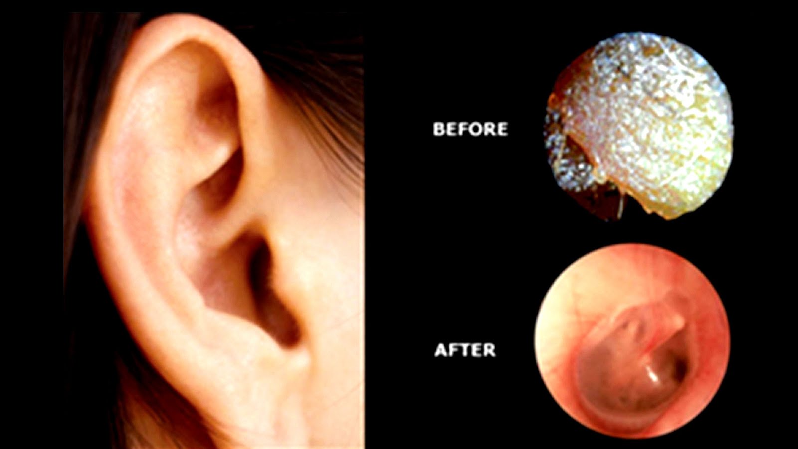 Tinnitus After Ear Wax Removal