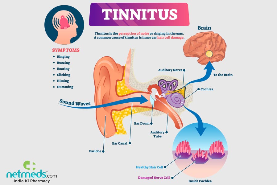 Tinnitus: Causes, Symptoms And Treatment