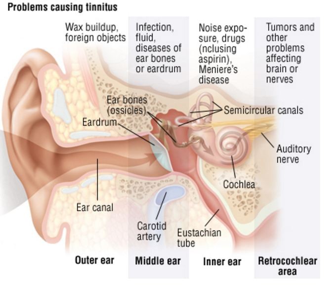 Tinnitus or that Maddening Ringing in the Ears is more Commo