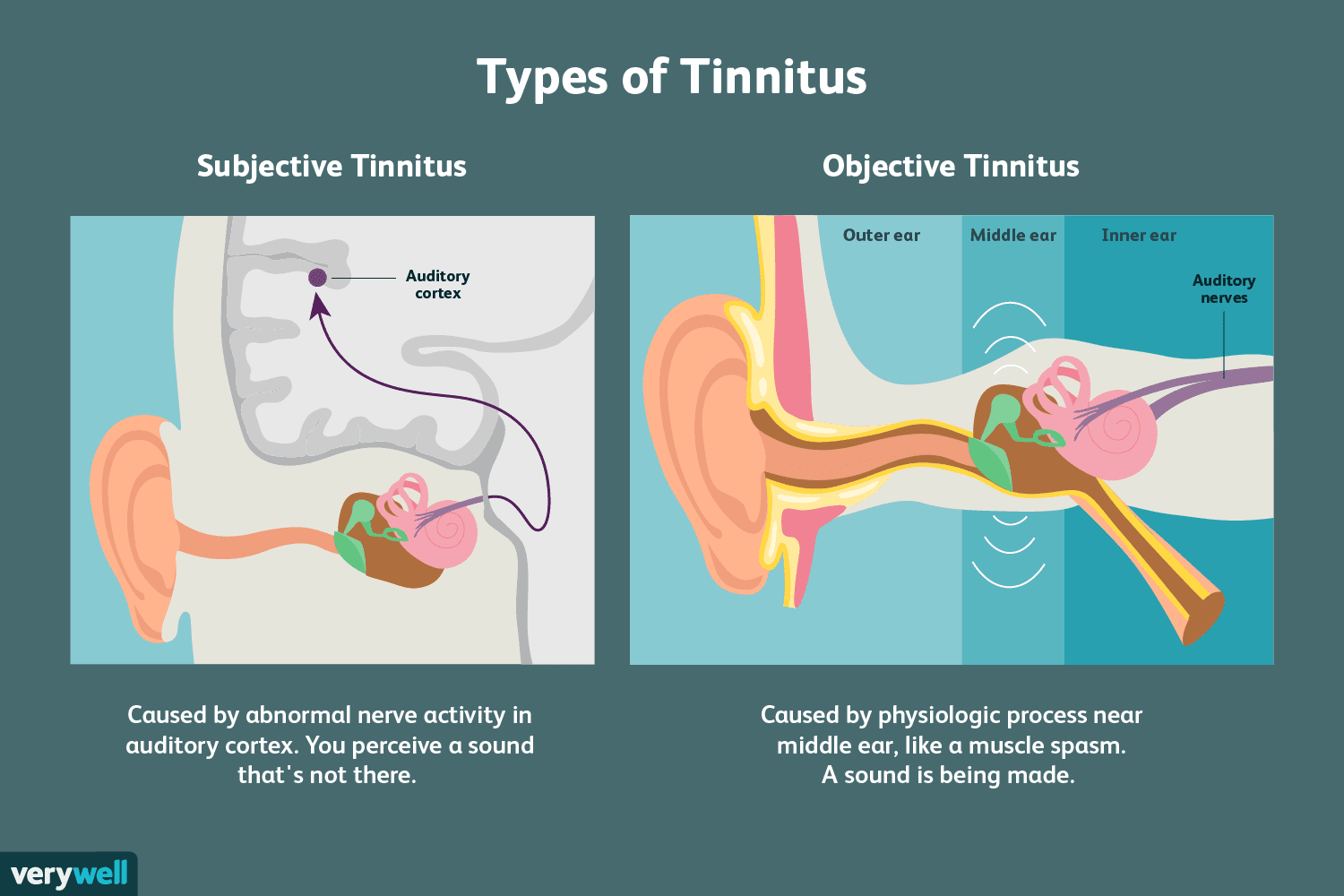 Tinnitus: Overview and More