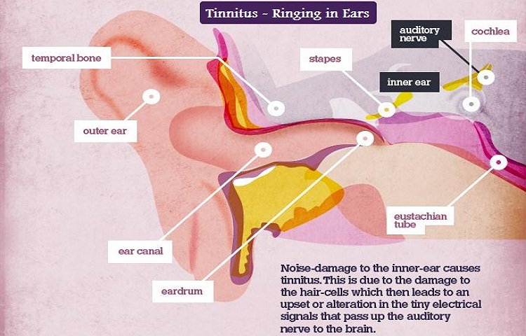 Tinnitus Remedies