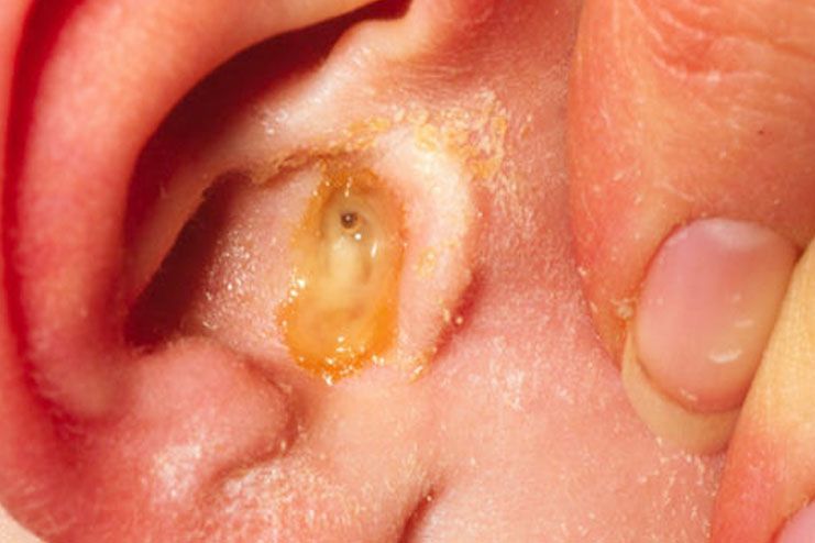 Tips to Use Garlic for Ear Infection