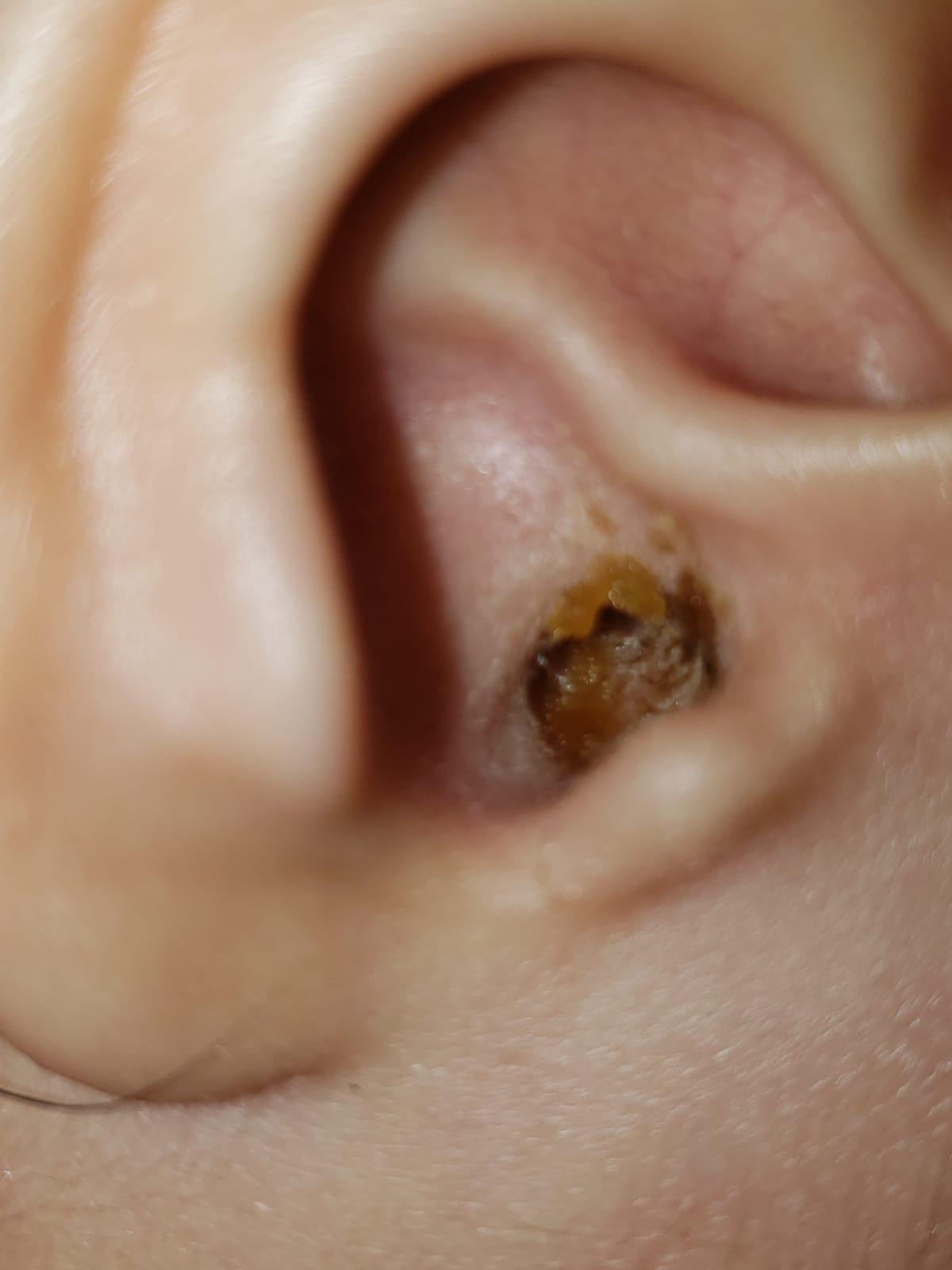 Two year old daughterâs ear, one week after ear infection (that was ...