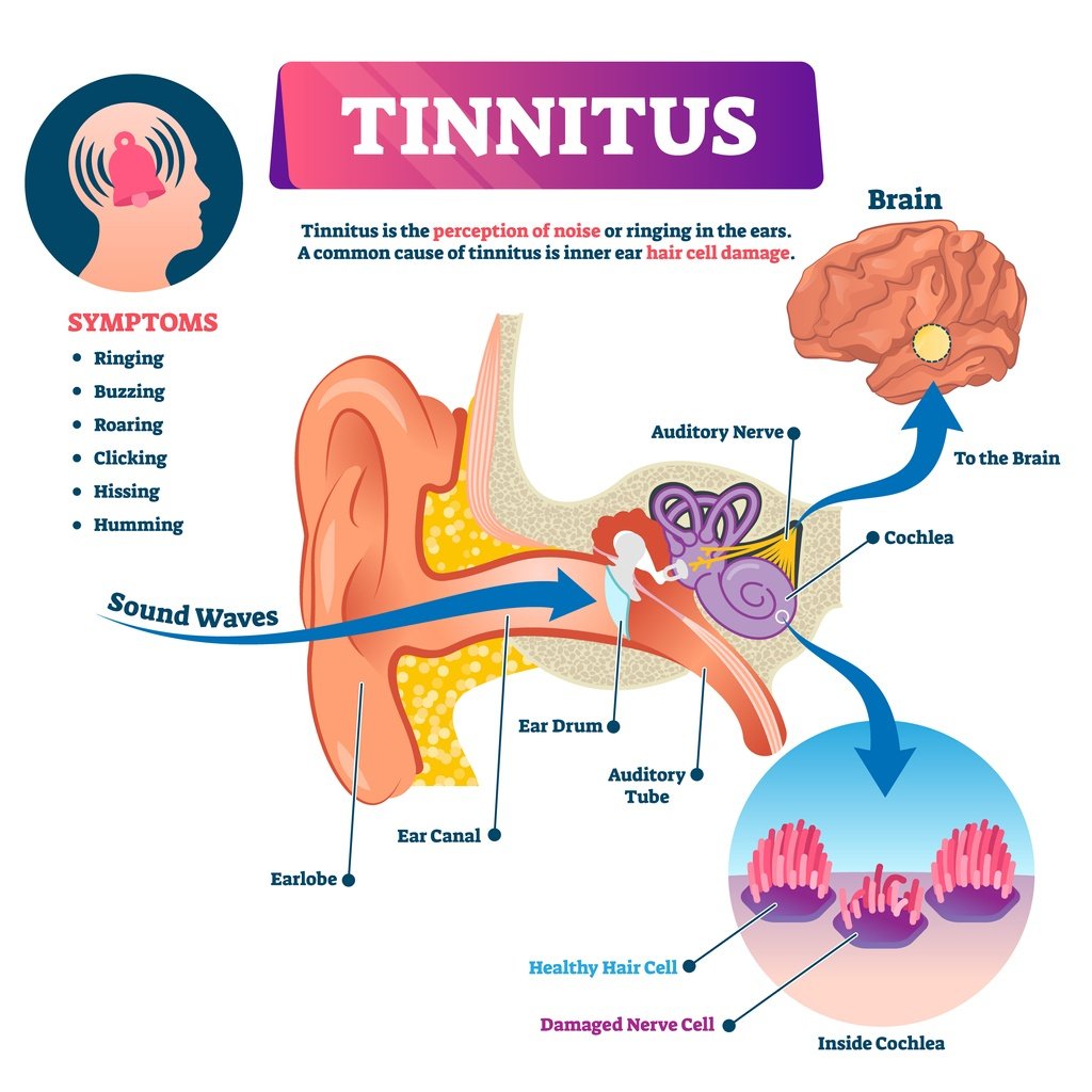 What Causes Tinnitus and How Can I Treat It?  The Alberta Retired ...
