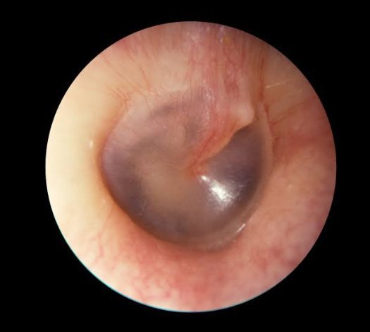 What does an ear infection look like in an otoscope?