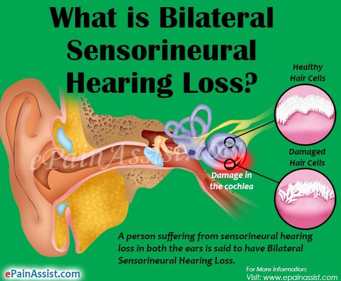 What is Bilateral Sensorineural Hearing Loss?