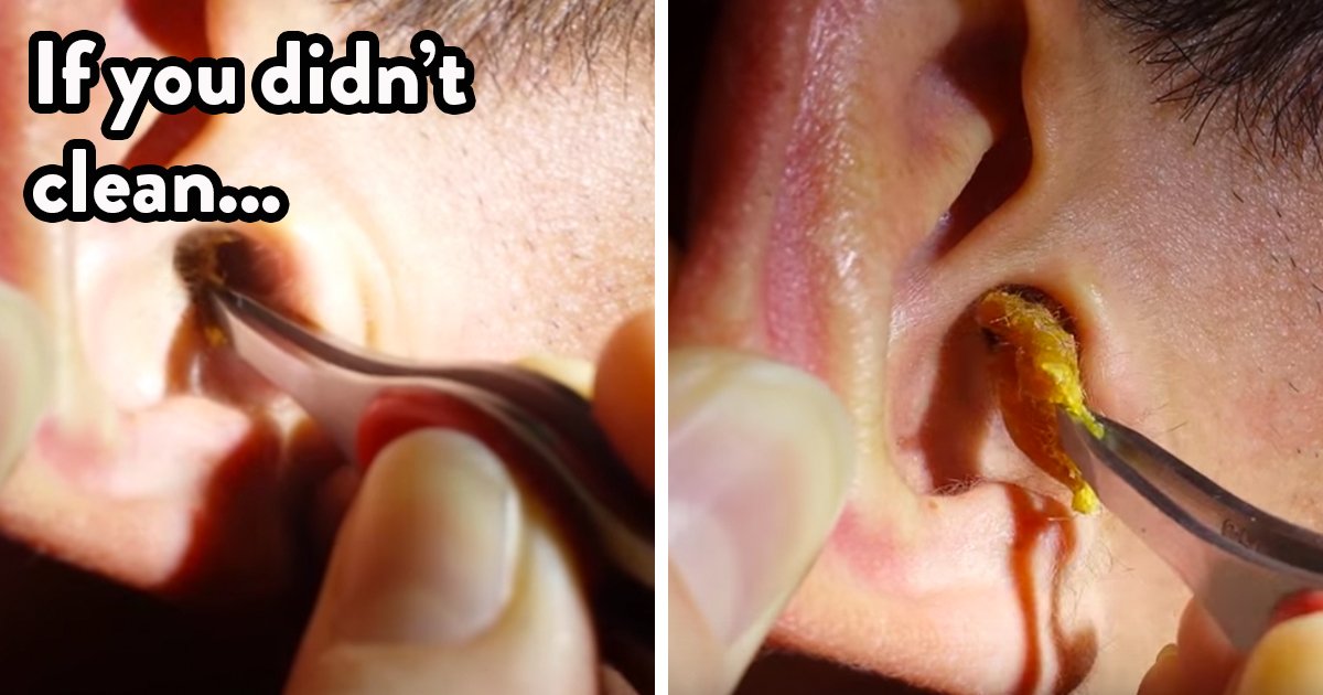 When to Clean out Earwax