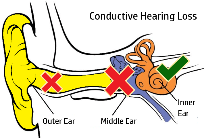 Why Cant I Hear? Types and Causes of Hearing Loss You ...