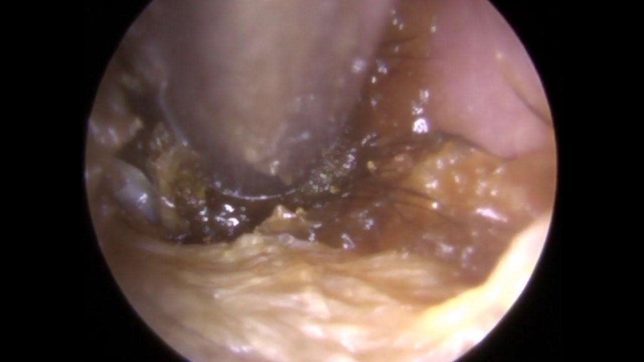 Will my tinnitus go away after removing ear wax ...